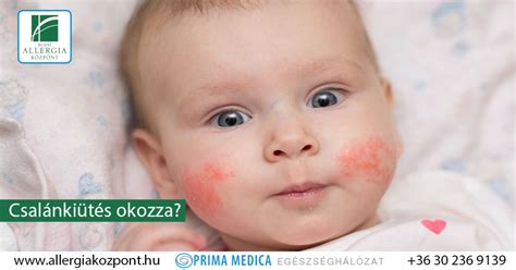 Csalánkiütés a gyermek bőrén