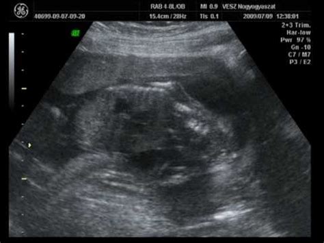 Ultrahang felvétel placenta praeviáról
