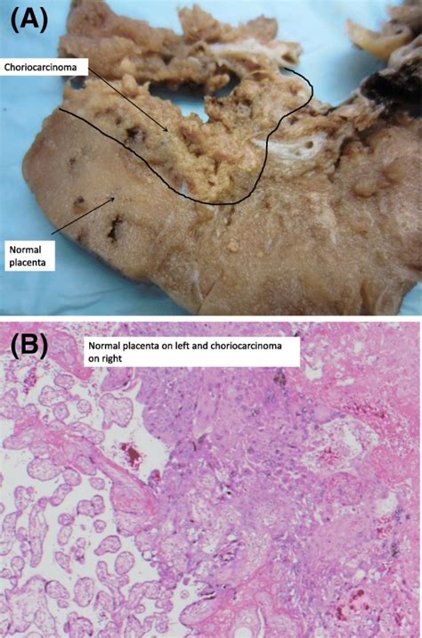 A choriocarcinoma lehetséges áttétei