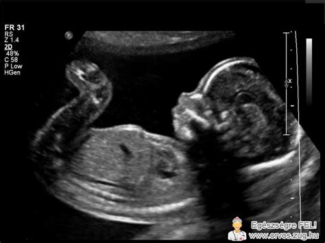 Ultrahang felvétel méh fejlődési rendellenességről