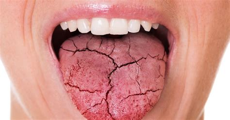 szájszárazság tünetei