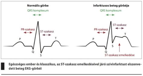 EKG görbe és szívritmus