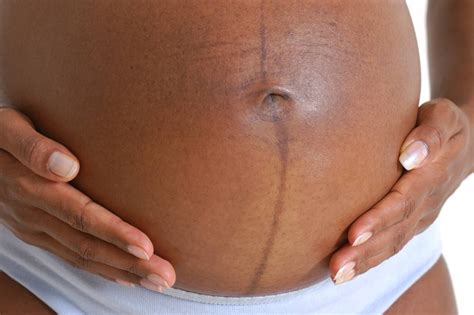 Terhességi pigmentációk: linea nigra és melasma