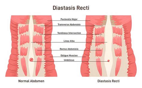 A rectus diastasis lehetséges tünetei és következményei