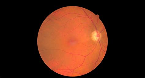 A méh fundus magasságának változása a gyermekágyban