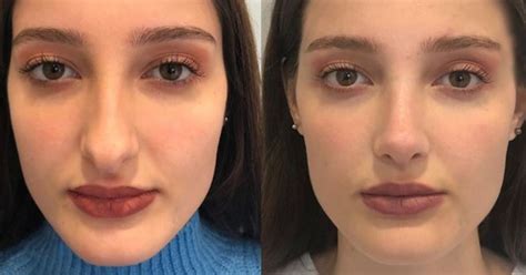 Plasztikai beavatkozások statisztikái szülés után