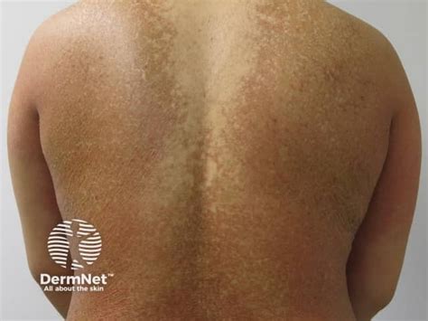 Malac parakeratosis tünetekkel