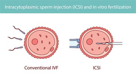 Sémája az IVF eljárás lépéseinek