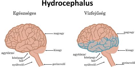 Hidrocefalusz (vízfejűség) sémája