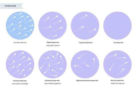 Spermiogram eredménye
