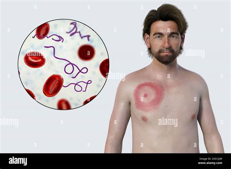 Lyme-folt (Erythema migrans)