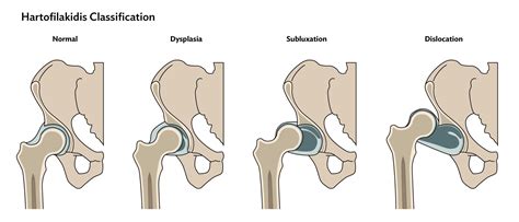 HIP Dysplasia Institute logó