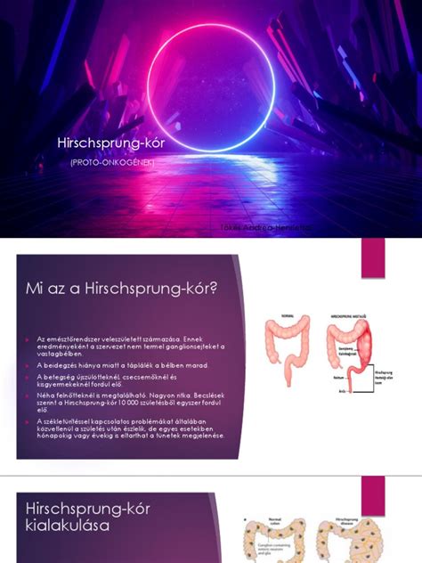 Hirschsprung-kór illusztráció
