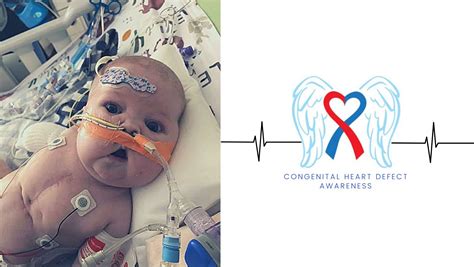 Gastroschisis illusztráció