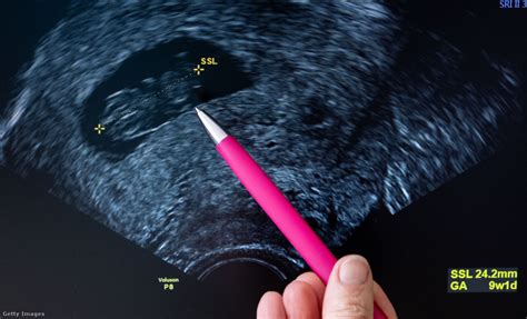 Hüvelyi ultrahangvizsgálat a tüszőnövekedés nyomon követésére