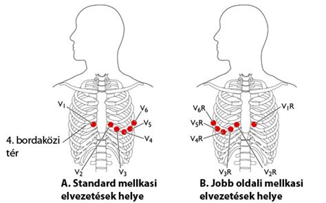Defibrillátor elektródák helyes elhelyezése gyermekeken