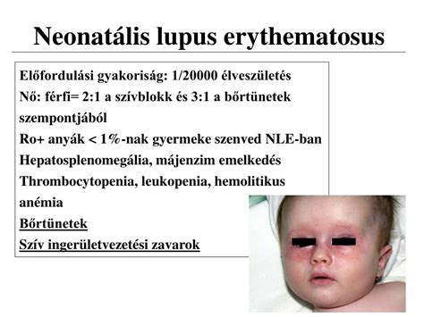 A neonatalis lupus tüneteit és diagnosztikáját bemutató diagram