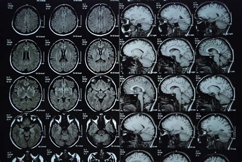 Agyi képalkotó vizsgálat (MRI)