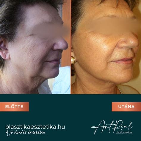 Babakellékek sterilizálása: Előtte és utána