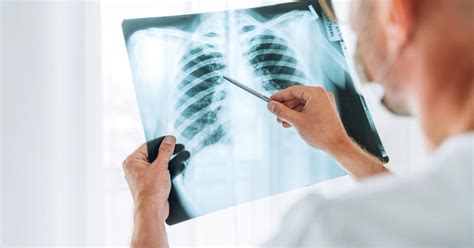 A tüdőszűrés jelentősége és a diagnosztizálható betegségek