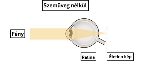 A csigolyaelcsúszás okai és típusai