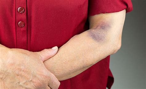 Véraláfutás a bőrön