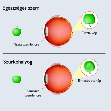 Gyermekfejfájás tünetei