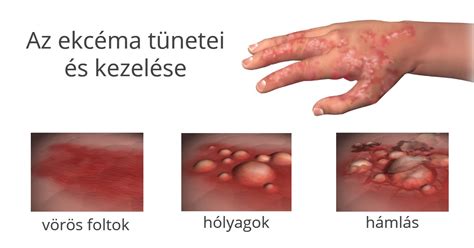 Az ekcéma tünetei és megjelenési formái