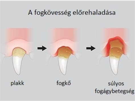 A fogkő kialakulása és hatása a gyermekek fogaira