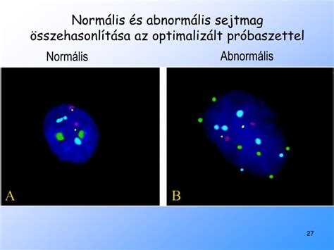Normál és abnormális spermiumok összehasonlítása
