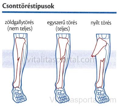 Nyílt és fedett csonttörés