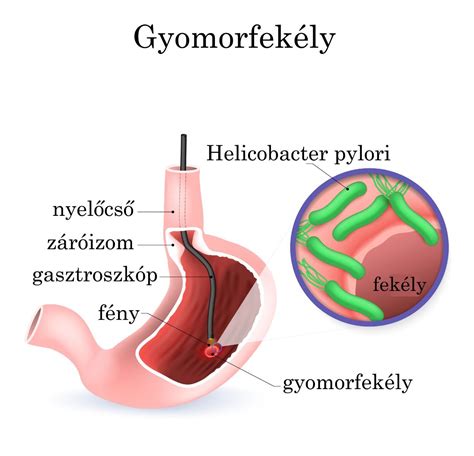 A gyomorfekély okai és tünetei