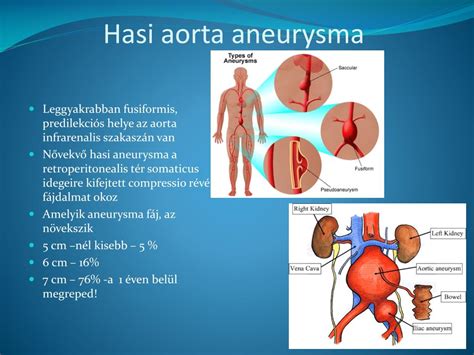 A hasi aorta aneurysma típusai és elhelyezkedése