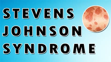Stevens-Johnson-szindróma tünetei