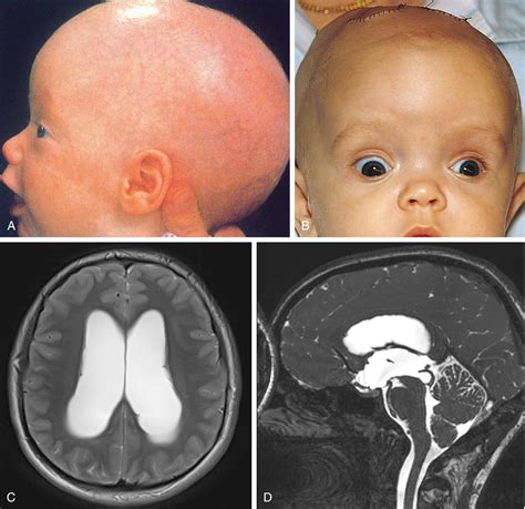Csecsemő a hydrocephalus tüneteivel