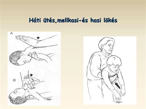 Háti ütés idegentest félrenyelése esetén