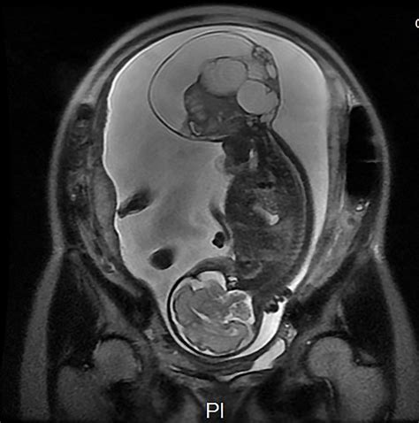 Érett cisztás teratoma MRI képe