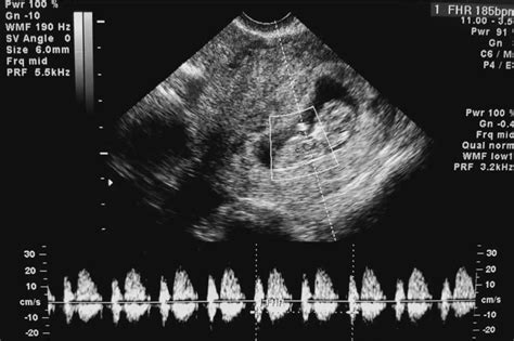 Fetus ultrahang képen Galen véna malformációval