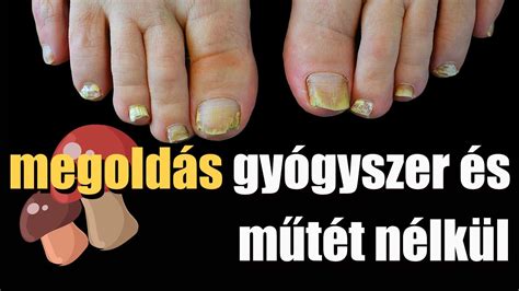 Körömgomba fertőzés a lábujjon