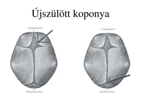 A kutacsok elhelyezkedése a csecsemő koponyáján