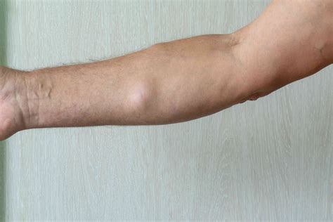 Zsírcsomó (lipoma) ábrázolása