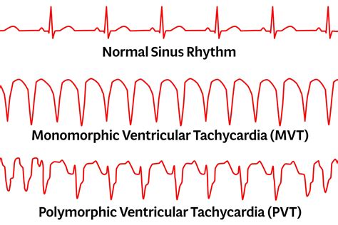 Gyermekkori tachycardia okai
