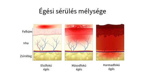 Elsősegély égési sérülés esetén