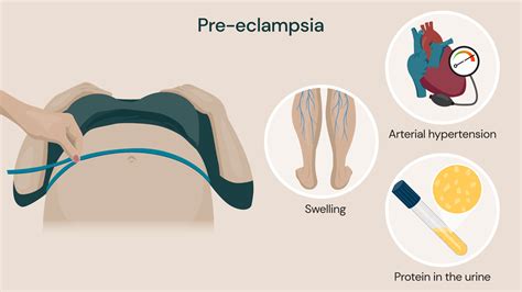 A preeclampsia tüneteit bemutató grafika