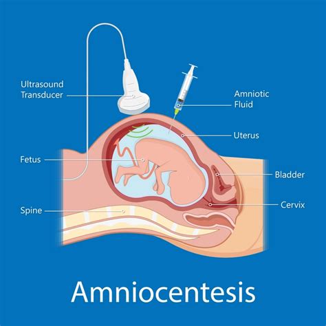 Amniocentesis folyamata