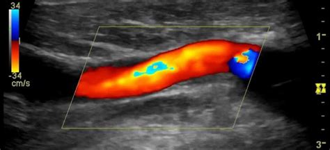 Doppler ultrahang elve