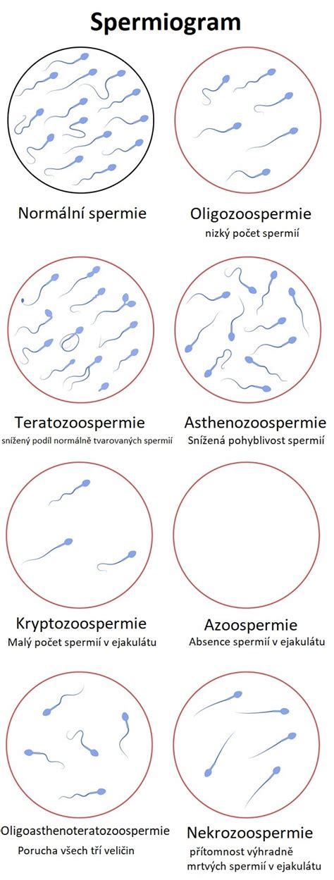 Spermiogram eredményeinek elemzése