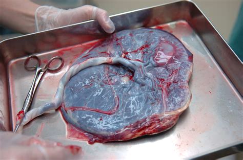 Statisztika a placenta leválás halálozási arányairól