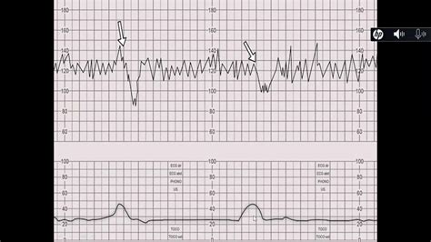 CTG görbe ábrázolása