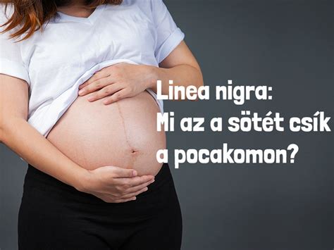 Linea nigra és melasma terhesség alatt